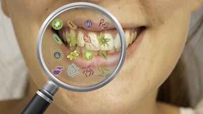 Oral bacteria may reveal risk for diabetes and cardiovascular disease -  School of Public Health - University of Minnesota